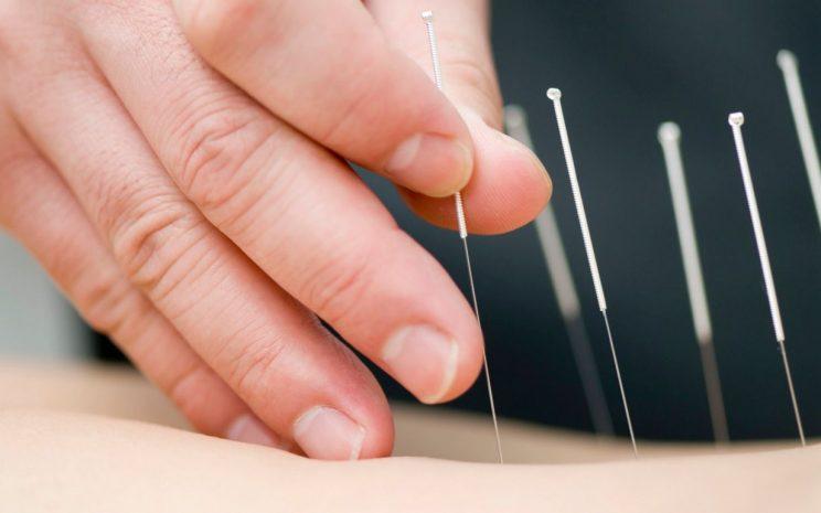 Acupuntura + Electroterapia